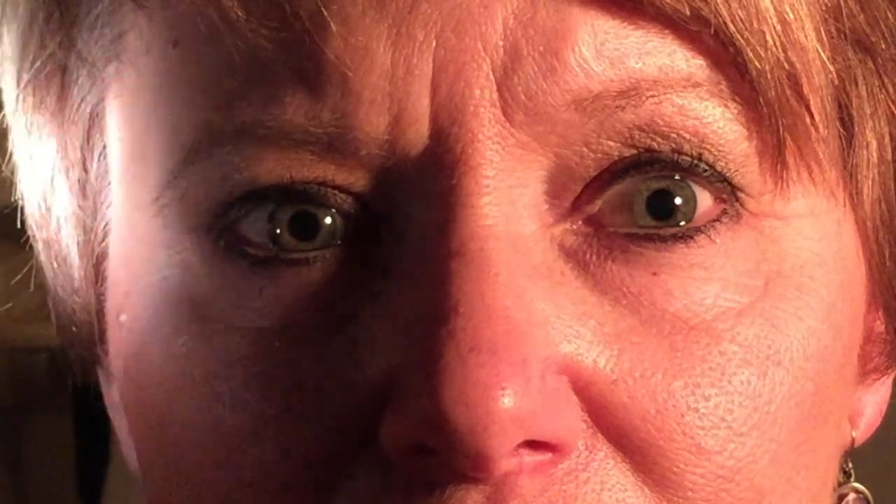 Relative Afferent Pupillary Defect (RAPD)